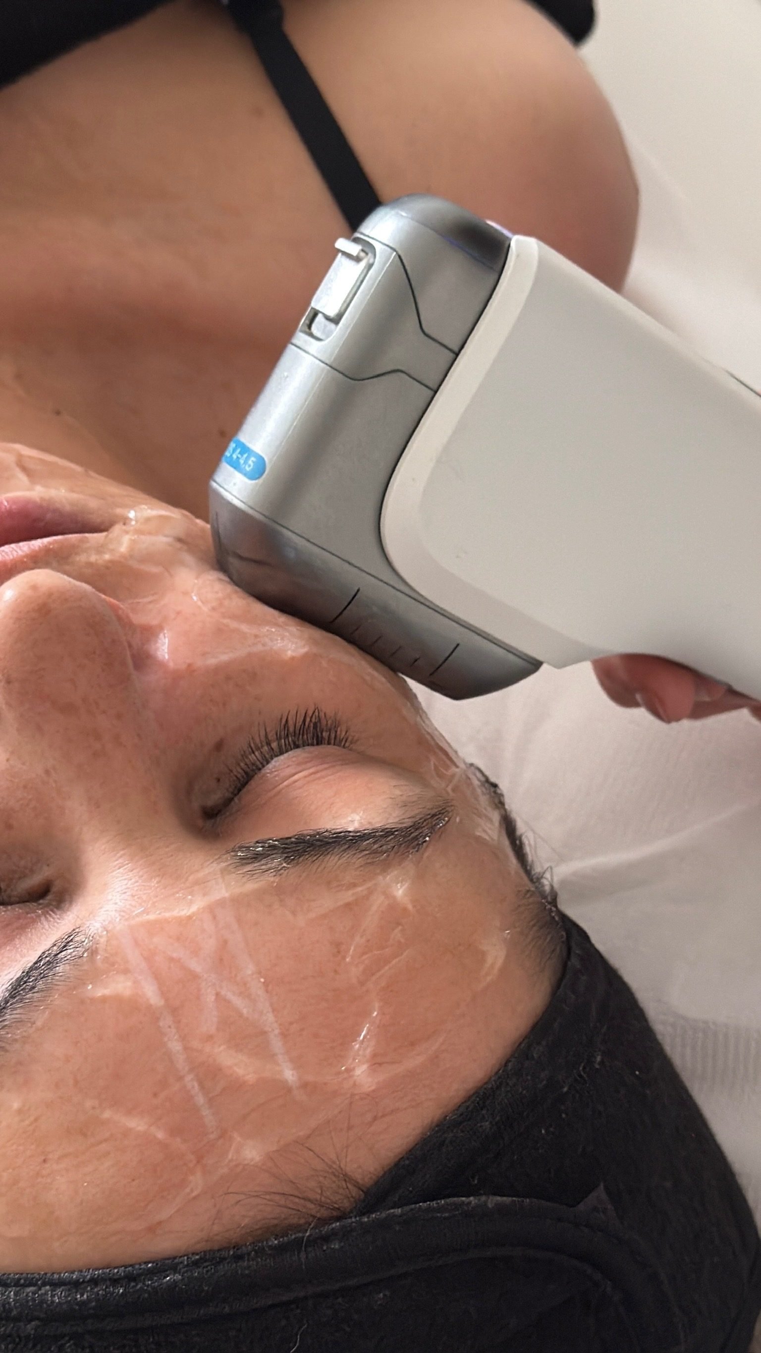 Soin HIFU visage réalisé chez Jude Aesthetic