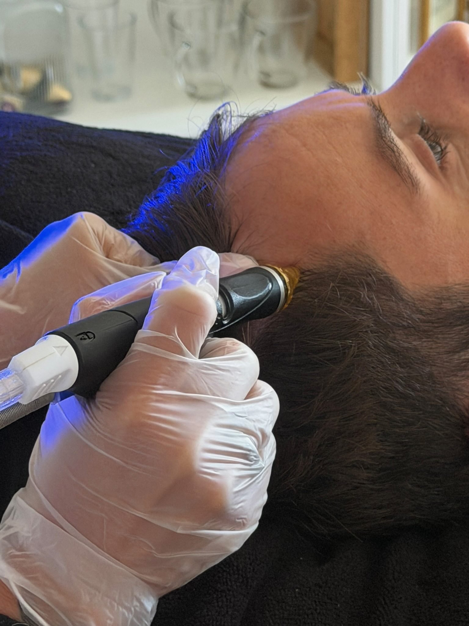 Soin Hydrafacial cuir chevelu réalisé chez Jude Aesthetic